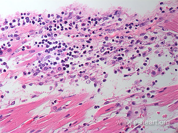 Endocardial severe rejection 02